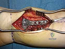 تورم وتشوه الرسغ