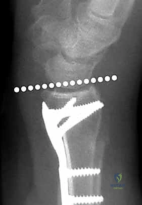 تقييم كسر الكعبرة البعيدة