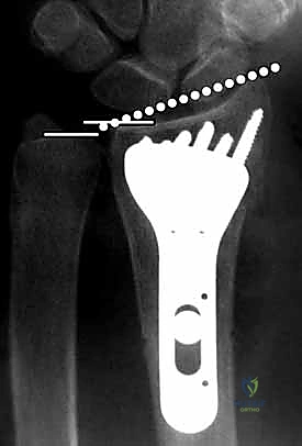 إرجاع العظام