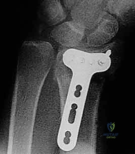 Illustration of lobster claw clamp - Dr. Mohammed Hutaif