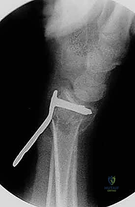 التحكم في التورم