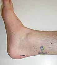 صورة توضيحية لـ استئصال وتر بلانتارس بالتدخل الجراحي المحدود: حل طبيعي لإصابات القدم والكاحل مع الأستاذ الدكتور محمد هطيف