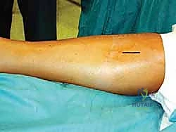 استئصال وتر بلانتارس بالتدخل الجراحي المحدود: حل طبيعي لإصابات القدم والكاحل مع الأستاذ الدكتور محمد هطيف