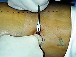 صورة توضيحية لـ استئصال وتر بلانتارس بالتدخل الجراحي المحدود: حل طبيعي لإصابات القدم والكاحل مع الأستاذ الدكتور محمد هطيف