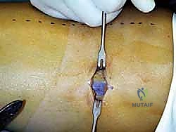 صورة توضيحية لـ استئصال وتر بلانتارس بالتدخل الجراحي المحدود: حل طبيعي لإصابات القدم والكاحل مع الأستاذ الدكتور محمد هطيف