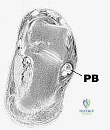 تشريح أوتار الشظية والهياكل المحيطة بها