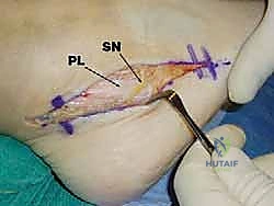 Illustration of peroneus brevis tendon - Dr. Mohammed Hutaif