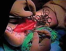 تثبيت الوتر المنقول في عظام القدم