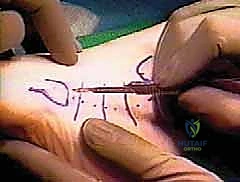 التشريح الدقيق لأوتار الشظية في الكاحل