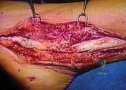 نقل وتر قابضة إبهام القدم الطويلة: حل متقدم لتمزقات أوتار الشظية المزمنة وآلام الكاحل