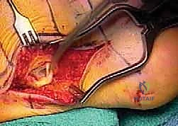 النتيجة النهائية لعملية نقل الوتر في الكاحل