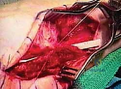 خطوات استخراج وتر قابضة إبهام القدم الطويلة FHL