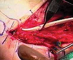 تشخيص تمزقات أوتار الكاحل المزمنة