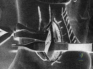 انخلاع الأوتار الشظوية في الكاحل: الأسباب، الأعراض، والعلاج المتقدم مع الأستاذ الدكتور محمد هطيف