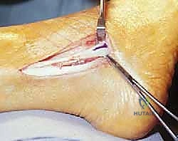 ميكانيكية انخلاع الأوتار الشظوية