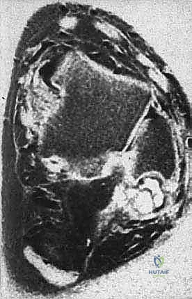 صورة توضيحية لـ انخلاع الأوتار الشظوية في الكاحل: الأسباب، الأعراض، والعلاج المتقدم مع الأستاذ الدكتور محمد هطيف