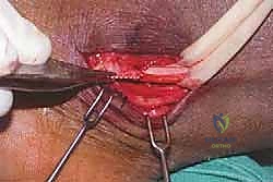 صورة طبية: انخلاع الأوتار الشظوية في الكاحل: الأسباب، الأعراض، والعلاج المتقدم مع الأستاذ الدكتور محمد هطيف