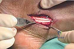 صورة طبية: انخلاع الأوتار الشظوية في الكاحل: الأسباب، الأعراض، والعلاج المتقدم مع الأستاذ الدكتور محمد هطيف