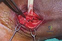 صورة توضيحية لـ انخلاع الأوتار الشظوية في الكاحل: الأسباب، الأعراض، والعلاج المتقدم مع الأستاذ الدكتور محمد هطيف