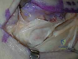 تنظيف مسار الوتر الشظوي