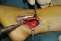 الإصابات الرياضية وتأثيرها على الكاحل