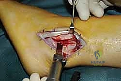 أشعة الرنين المغناطيسي للكاحل