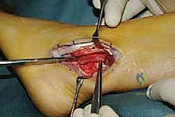 التشخيص السريري لعدم استقرار الكاحل