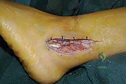 تقييم حالة الأوتار الشظوية أثناء الجراحة