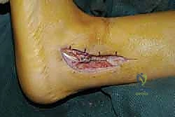 تعميق التلم الشظوي لضمان استقرار الوتر