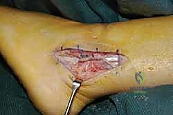 العلاج التحفظي لإصابات الكاحل