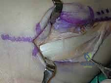 صورة طبية: انخلاع الأوتار الشظوية في الكاحل: الأسباب، الأعراض، والعلاج المتقدم مع الأستاذ الدكتور محمد هطيف