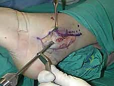 تجهيز المريض للتدخل الجراحي الدقيق