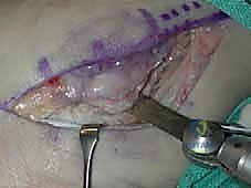 تجهيز السمحاق لتعزيز الرباط