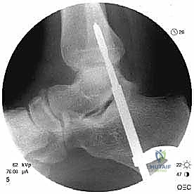 Superior Peroneal Retinaculoplasty with Periosteal Flap Augmentation for Dislocating Peroneal Tendons: An Intraoperative Masterclass