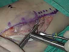 الشق الجراحي وكشف الأوتار