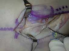 خياطة الأنسجة بدقة متناهية