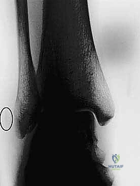 تسطح الميزاب الشظوي بالرنين المغناطيسي