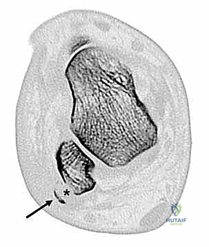 التصوير الشعاعي للكاحل