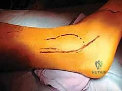 صورة رنين مغناطيسي توضح خلع الأوتار