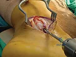 الشق الجراحي للكاحل