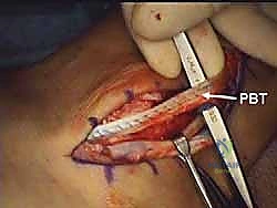 تفاصيل الميزاب الشظوي التشريحية