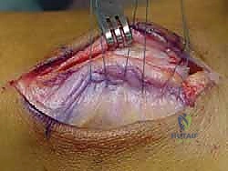 تآكل مفصل الكاحل