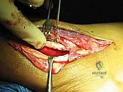 البروفيسور محمد هطيف أثناء الجراحة