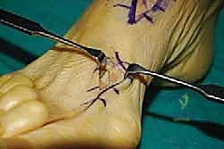 صورة توضيحية لـ إعادة بناء وتر الظنبوب الأمامي بنقل وتر EHL علاج متقدم لقطع القدم في صنعاء مع الأستاذ الدكتور محمد هطيف