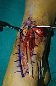 التحضير لجراحة إعادة بناء وتر الظنبوب الأمامي في صنعاء