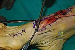 Tibialis Anterior Tendon Reconstruction with EHL Transfer: An Intraoperative Masterclass