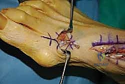 تثبيت وتر EHL في العظم الإسفيني الإنسي