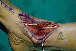 الخياطة والإغلاق بعد نجاح عملية إعادة بناء الوتر