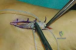 تأثير تدلي القدم على المشي