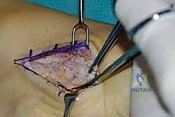 نقل وتر الظنبوب الخلفي الديناميكي لعلاج تدلي القدم: استعادة الحركة والحياة الطبيعية مع الأستاذ الدكتور محمد هطيف